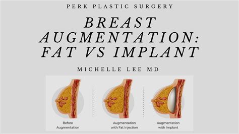 busty areolas|Reston VA Nipple Reconstruction 